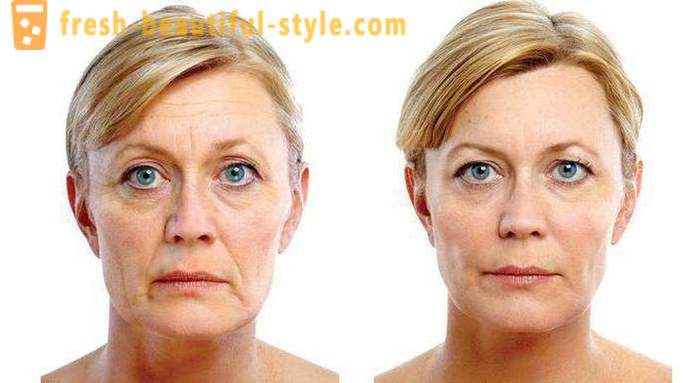 RF-ansigtsløftning: anmeldelser af læger kosmetologer, beskrivelse af proceduren, kontraindikationer. RF-ophævelse