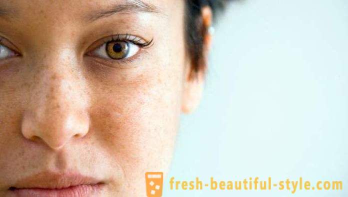 Brune pletter i ansigtet: årsagerne til og behandlinger. brune pletter