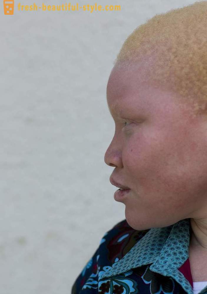 Den tragiske historie tanzanianske albinoer