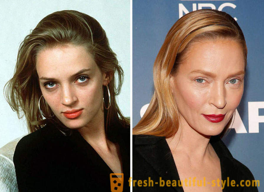 15 berømtheder, færdig dårligt med Botox