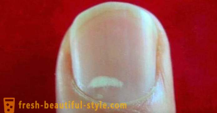 Hvide pletter på neglene af fingrene: årsagerne til og behandling