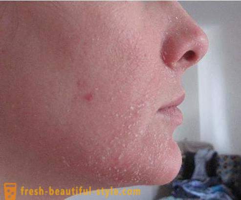 Hvorfor skællende hud i ansigtet? Problem ansigtshuden