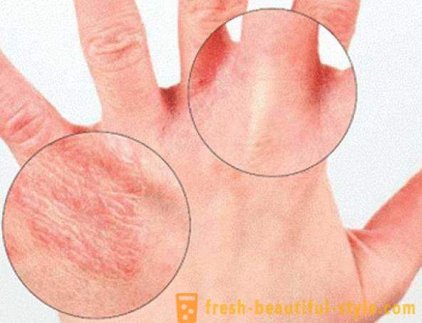 Tør hud af hænder: Forårsager. Meget tør hud, hvad man skal gøre?