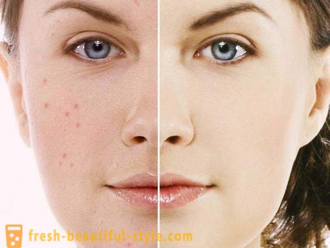 Badyaga plet af acne: anmeldelser. Badyaga (gel) af alderspletter