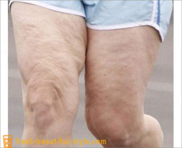 Hvordan at slippe af med cellulite på benene? Øvelser for benene af cellulite