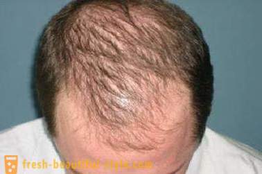 Sådan fremskynde væksten af ​​hår på hovedet? Restaurering af hårvækst