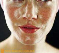 Fedtet hud ansigt: hvad man skal gøre for at løse problemet?