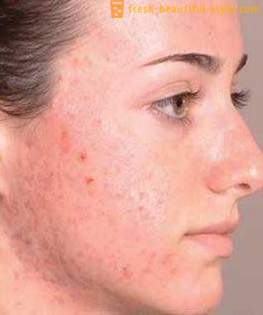 Hvordan at slippe af med spor efter acne og genoprette huden flot udsigt?