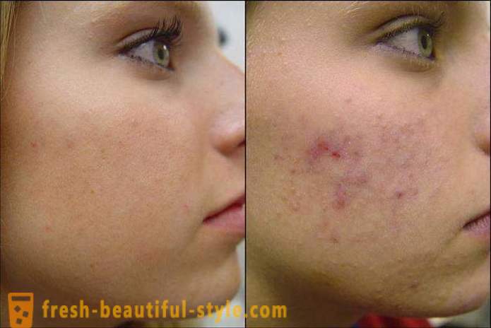 Hvordan til at rense dit ansigt af acne, så de ikke længere tilbage